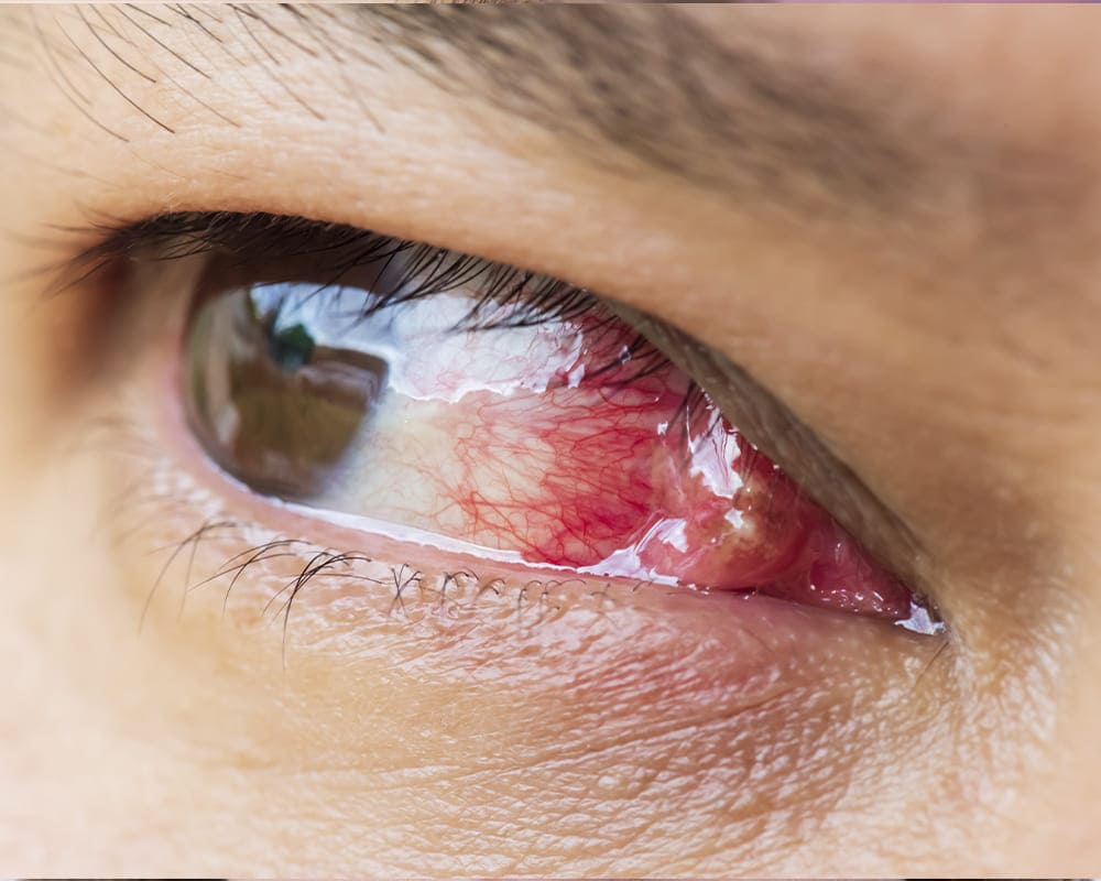 Pterigión (carnosidad)